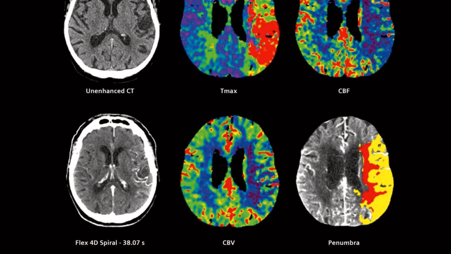 Total CT Stroke Imaging