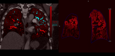 lung perfusion