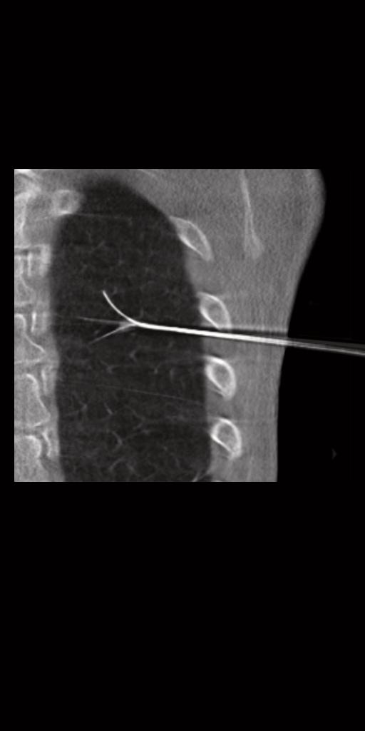 Clinical image showing verification of correct placement of RF needle using syngo Dyna3D
