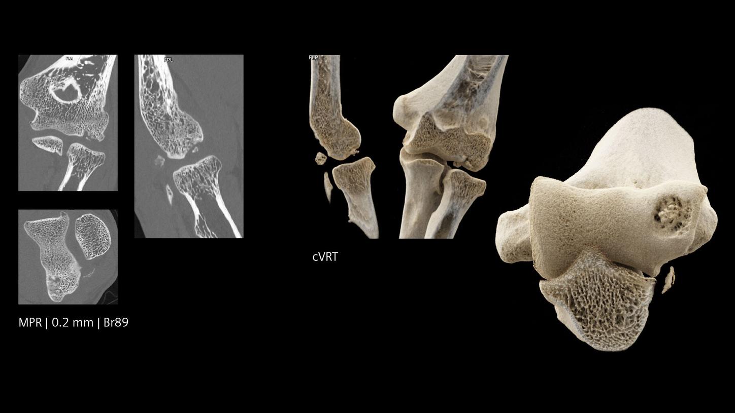 Clinical images of an osteochondritis dissecans of the capitellum, elbow of a 13-year-old patient
