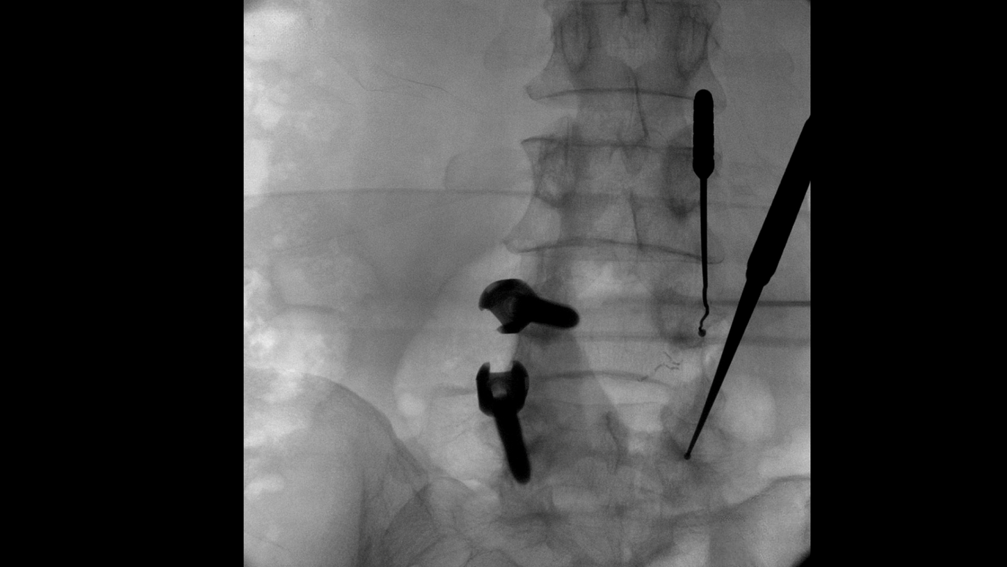 Lumbar spine surgery with Cios Fit, a mobile 2D C-arm for surgery.