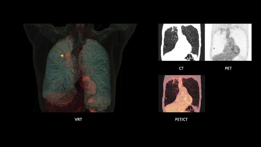 Biograph Vision clinical case