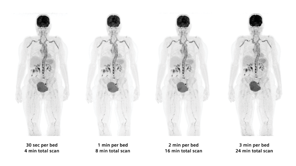 Biograph Vision clinical case