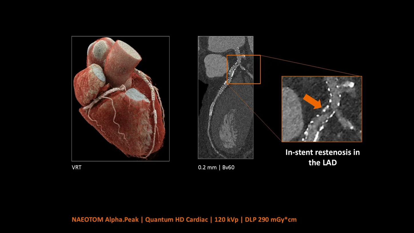 Cardiovascular in-stent restenosis