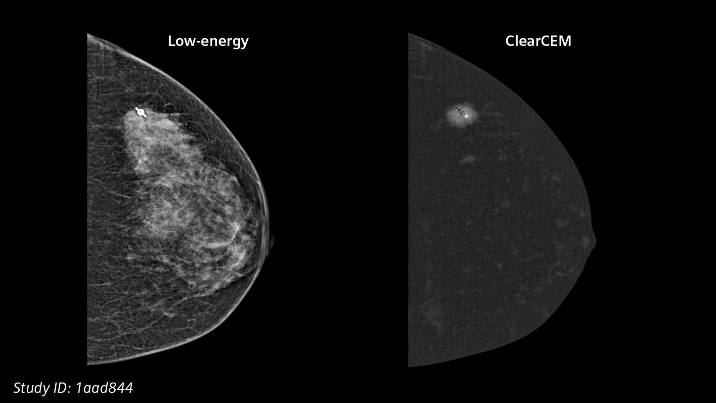 ClearCEM clinical case: Invasive ductal carcinoma