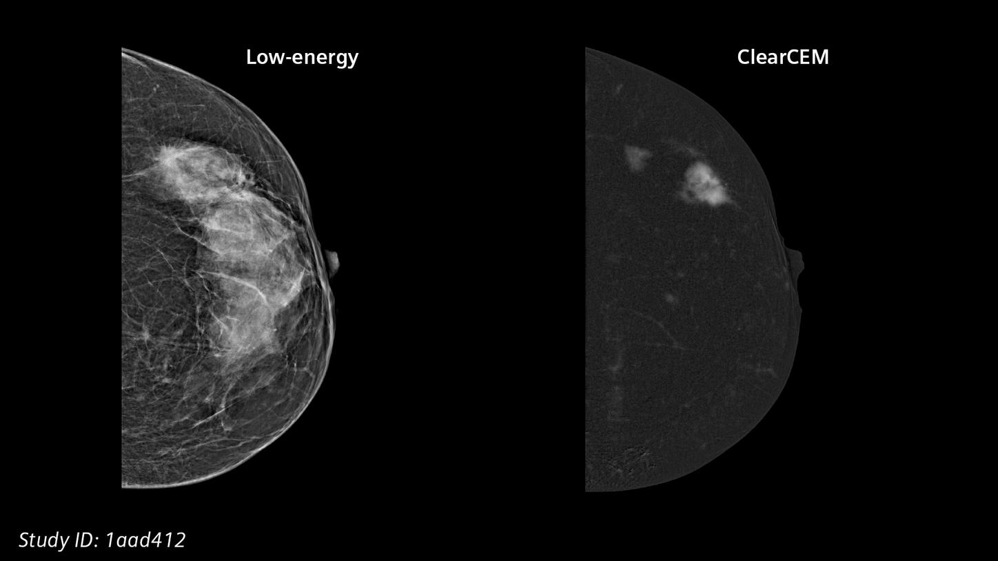 ClearCEM clinical case: Multifocal invasive lobular cancer