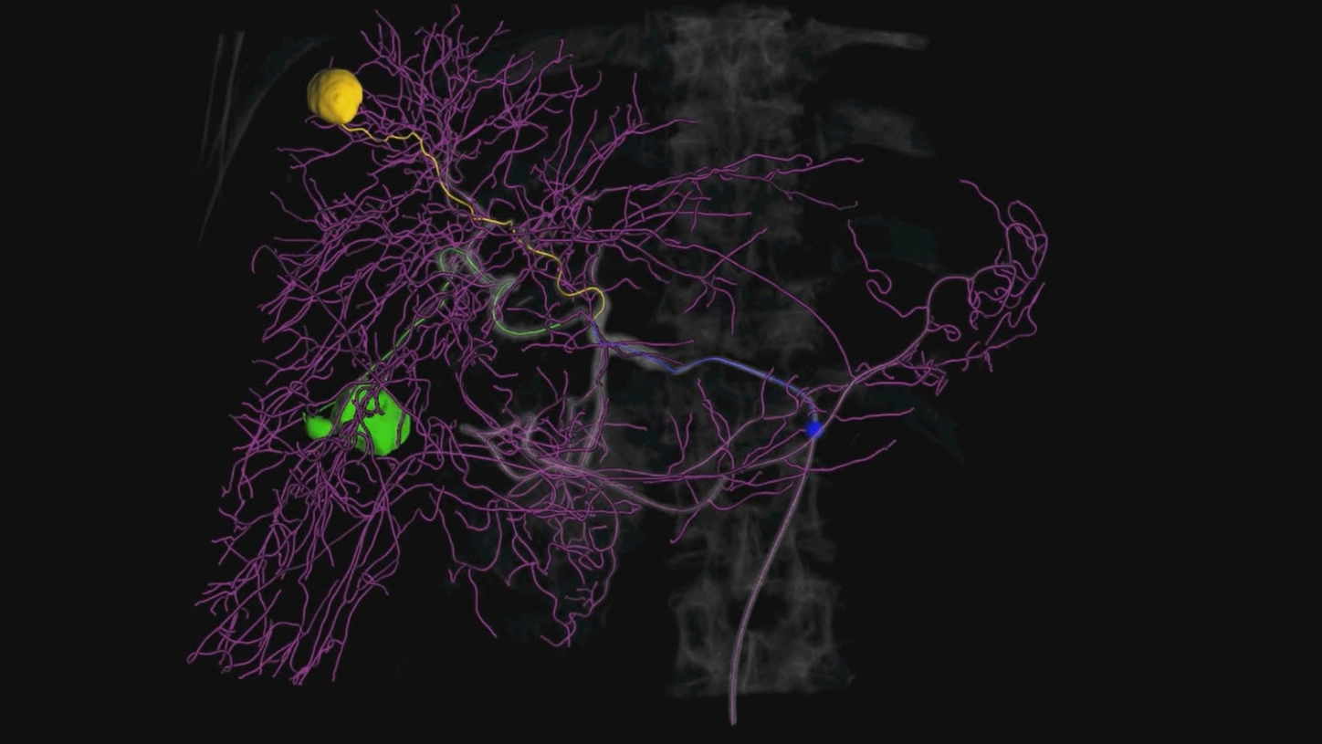 Automatic identification of the entire vessel tree with clear differentiation between feeder and non-feeder vessels for confident planning and precise navigation.