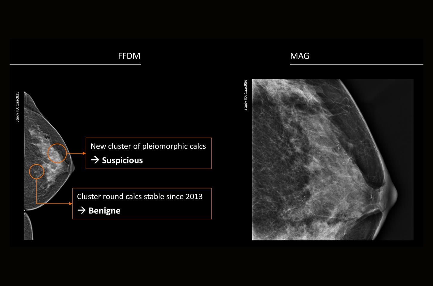 Microcalcificaciones pleomórficas en mama izquierda: diagnóstico de carcinoma ductal in situ grado 2