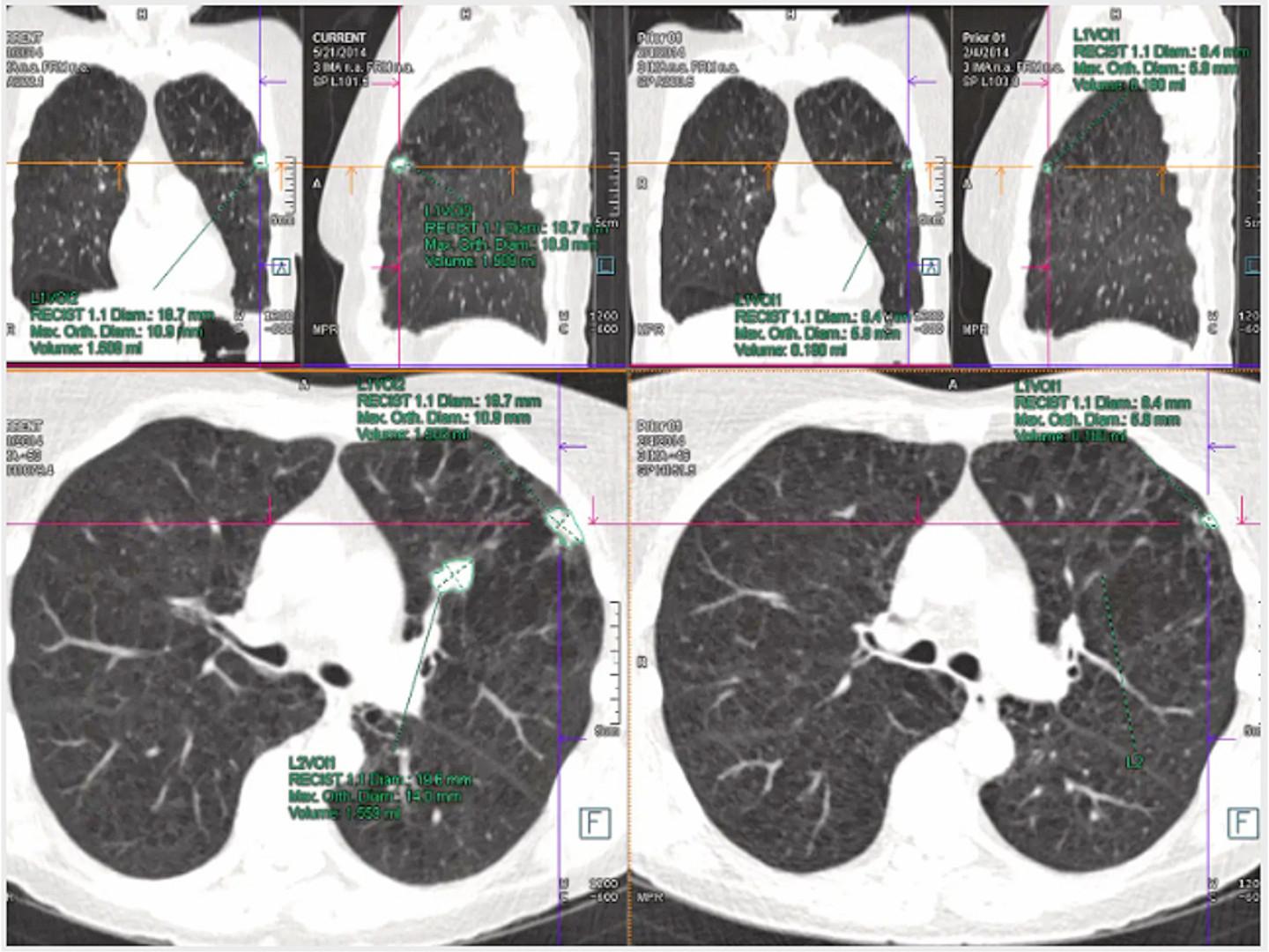 Diagnosis And Treatment Of Lung Cancer Siemens Healthineers Diagnosis And Treatment Of Lung Cancer Siemens Healthineers