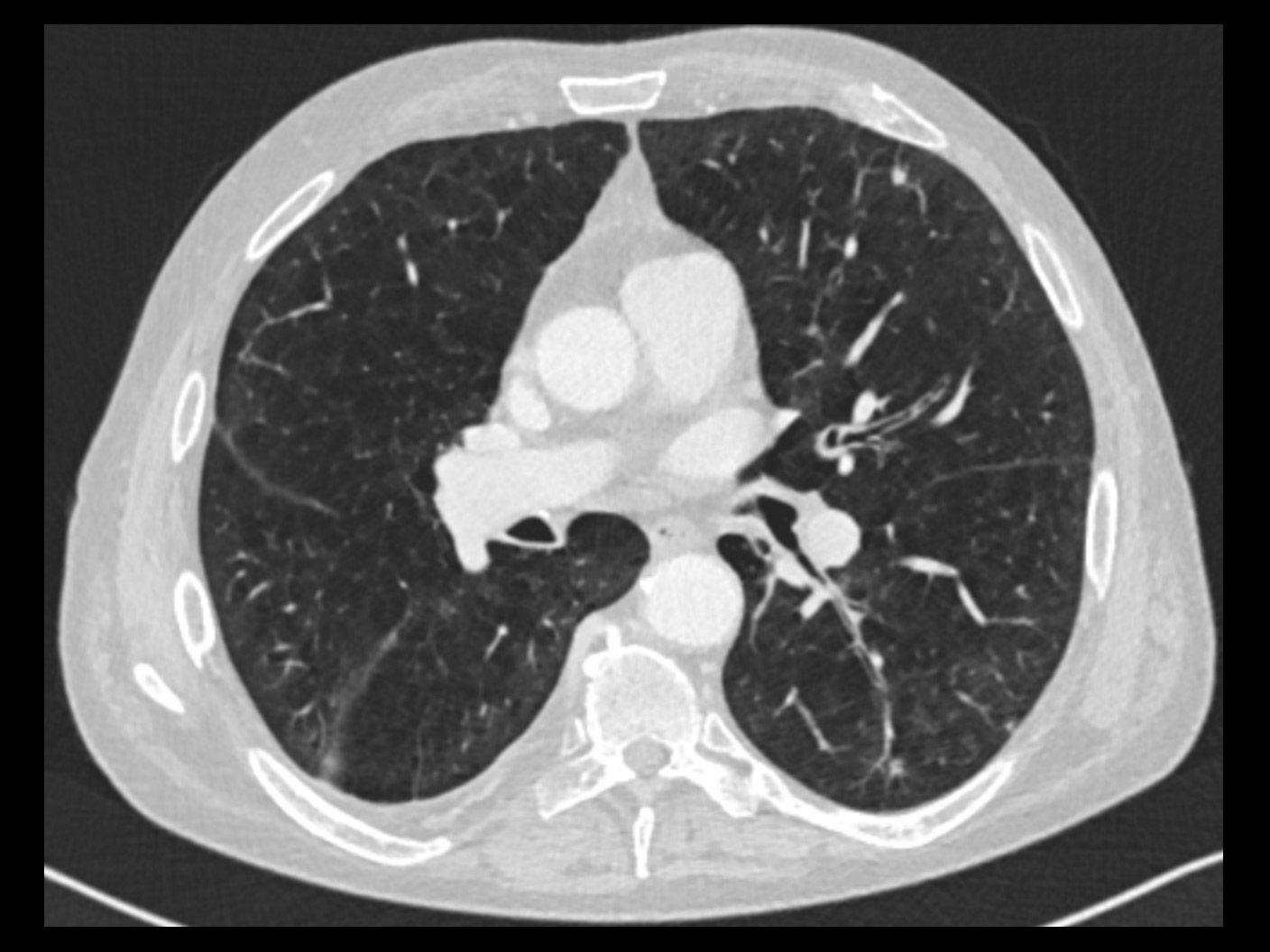 axial lung AIRC