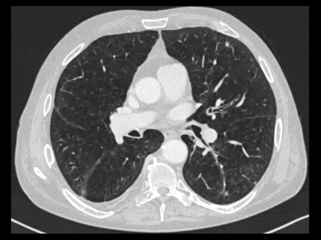 Build a Mobile Lung Cancer CT Screening Program - Siemens Healthineers USA