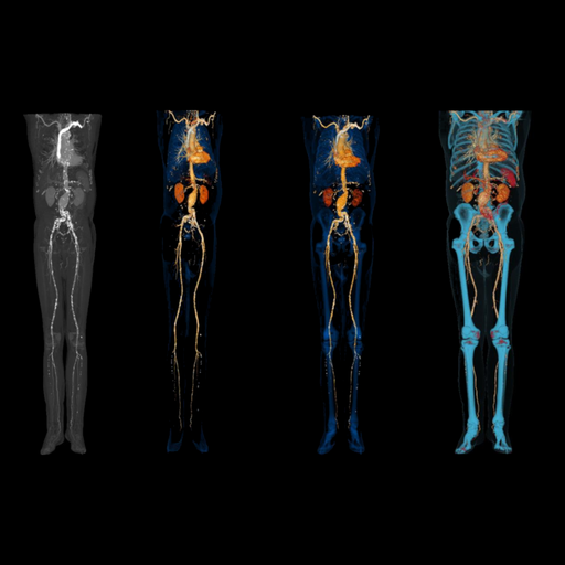Dual Energy CT Spectral Imaging - Siemens Healthineers USA