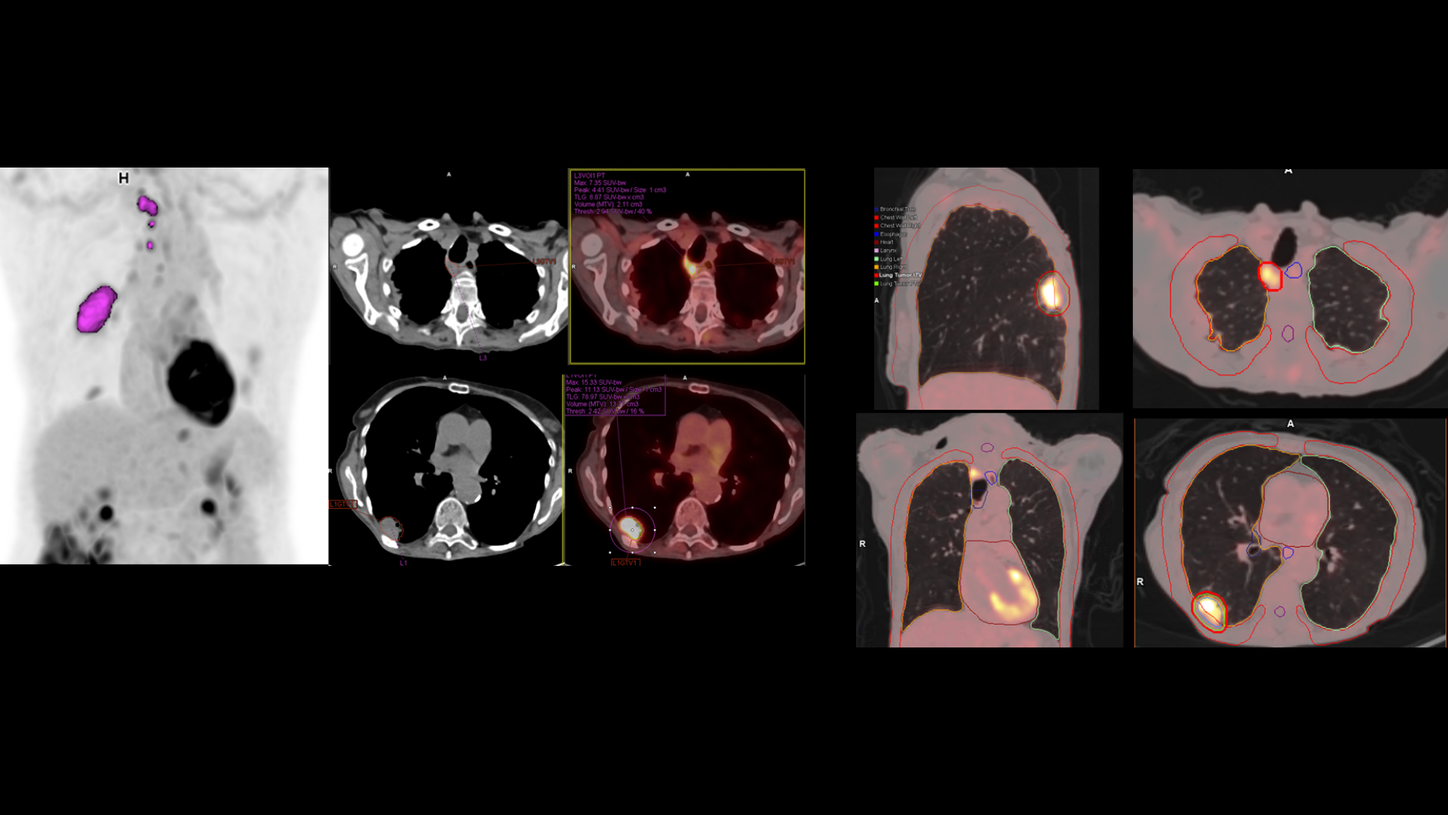 Lung Cancer