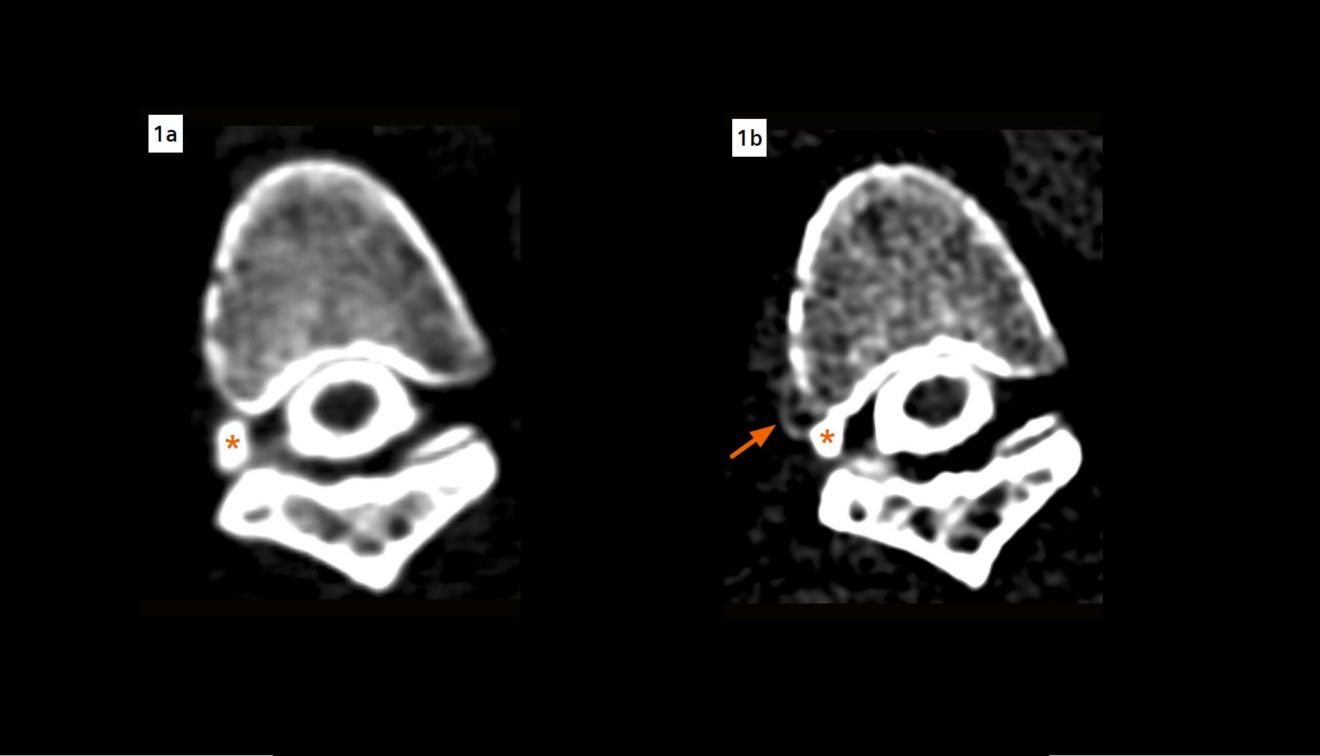 cerebrospinal-fluid-venous-fistula-detected-in-a-patient-with-a-long