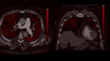 Spectral MPR reformats iodine maps