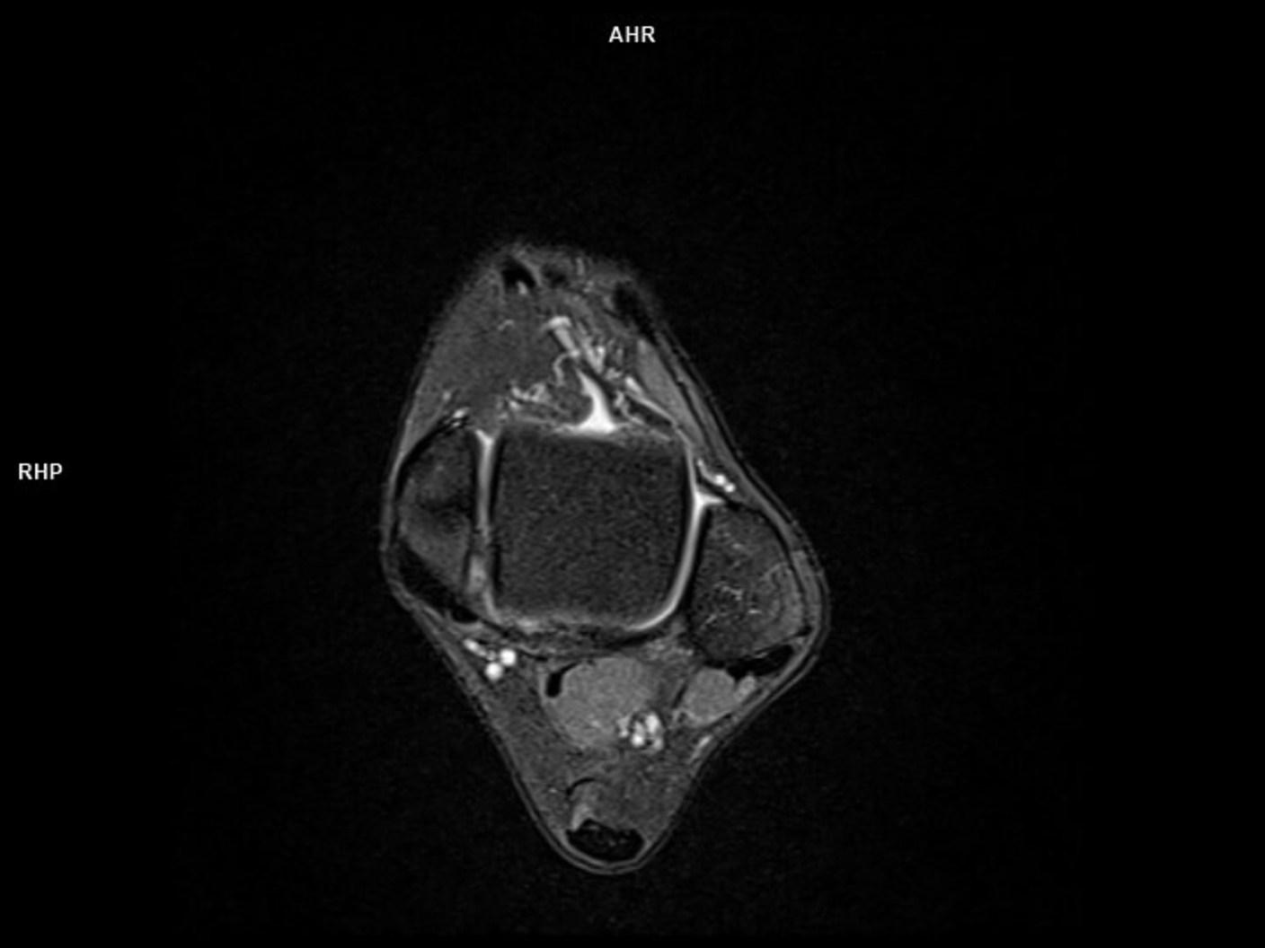 PD FS Tra-MAGNETOM Sola