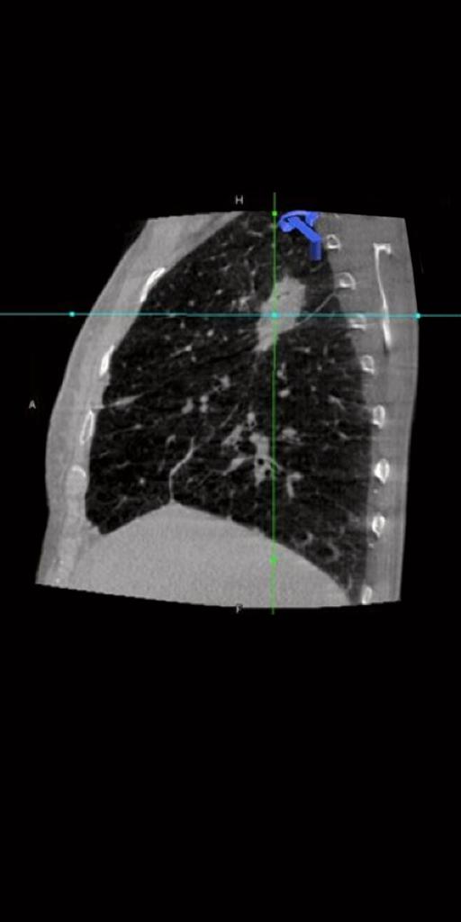 Clinical image of lung nodule acquired with syngo DynaCT