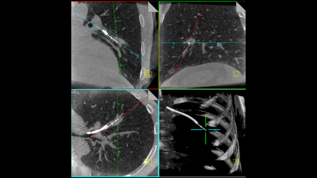Lung Care Imaging Solutions - Siemens Healthineers USA