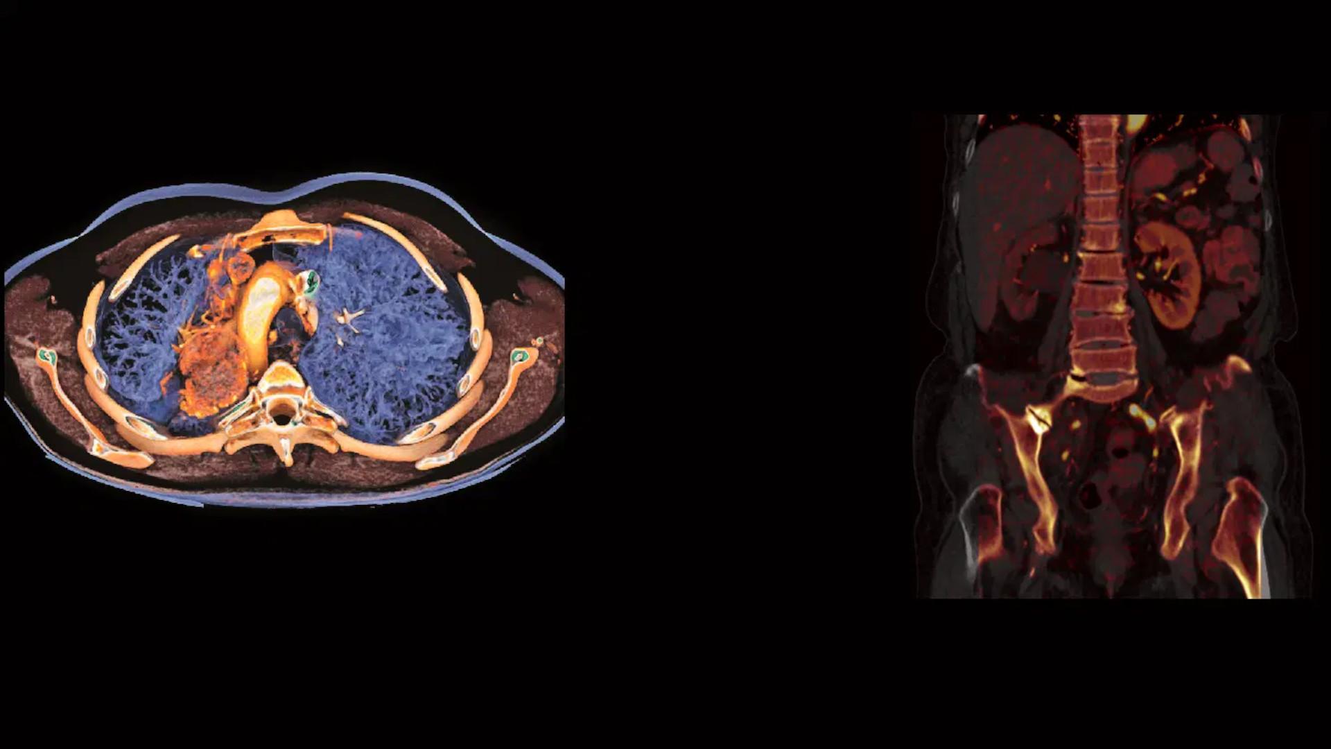 Diagnosis And Treatment Of Lung Cancer - Siemens Healthineers