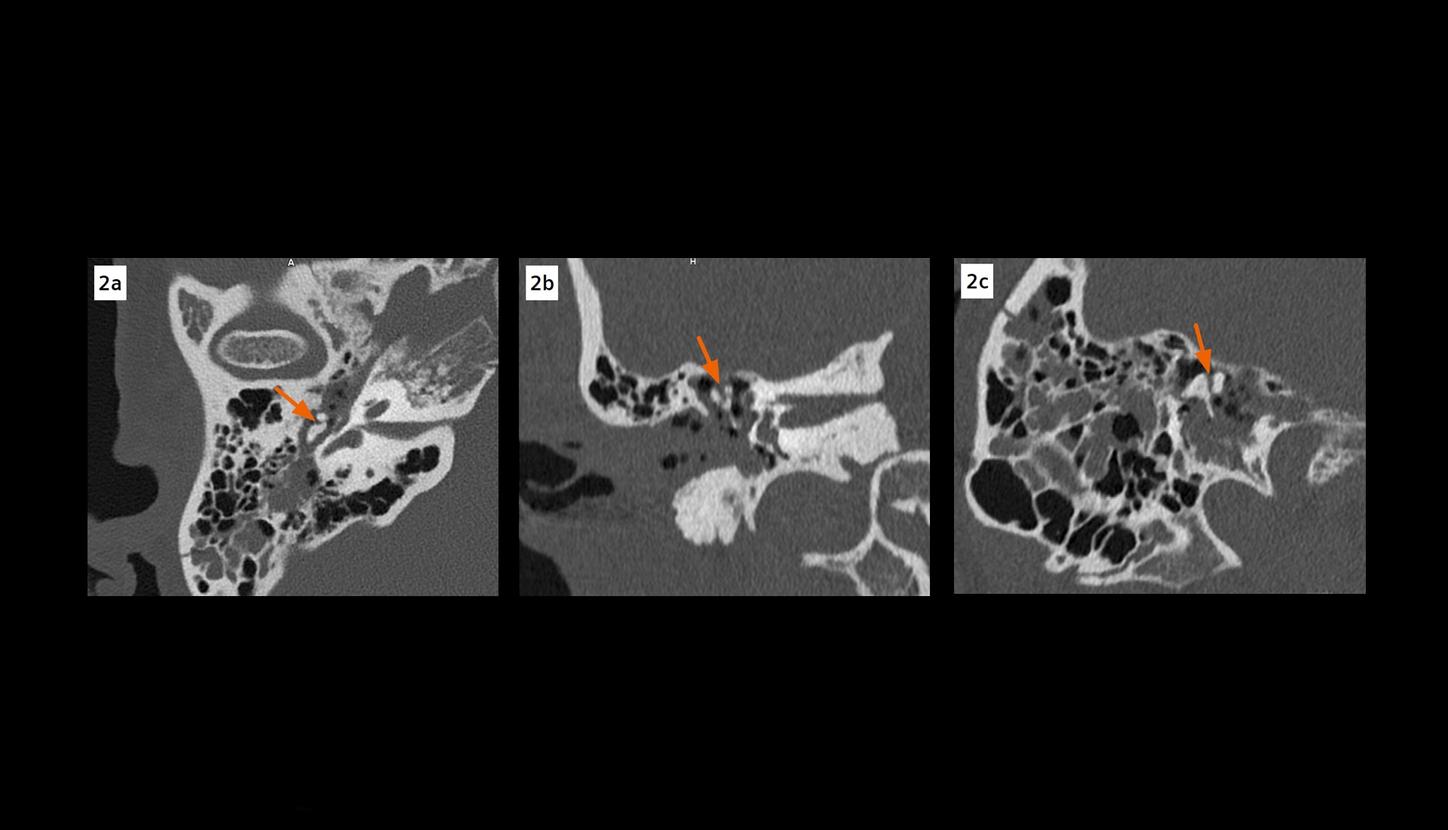 Images from zoomed reconstructions show the incudomalleolar dislocation with signs of disarticulated “ice cream cone” and “broken heart” in details.