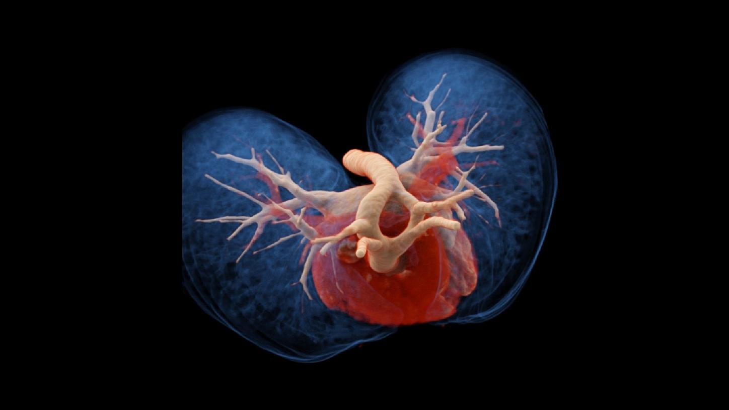 A cVRT image shows a patent double aortic arch, with the right dominant arch. Each arch gives rise to ipsilateral separate carotid and subclavian arteries, according to the four-artery sign.