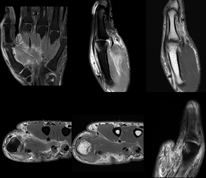 MRI thumb Findings