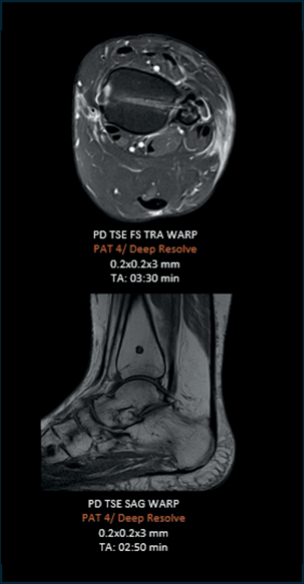 Deep resolve MRI ankle