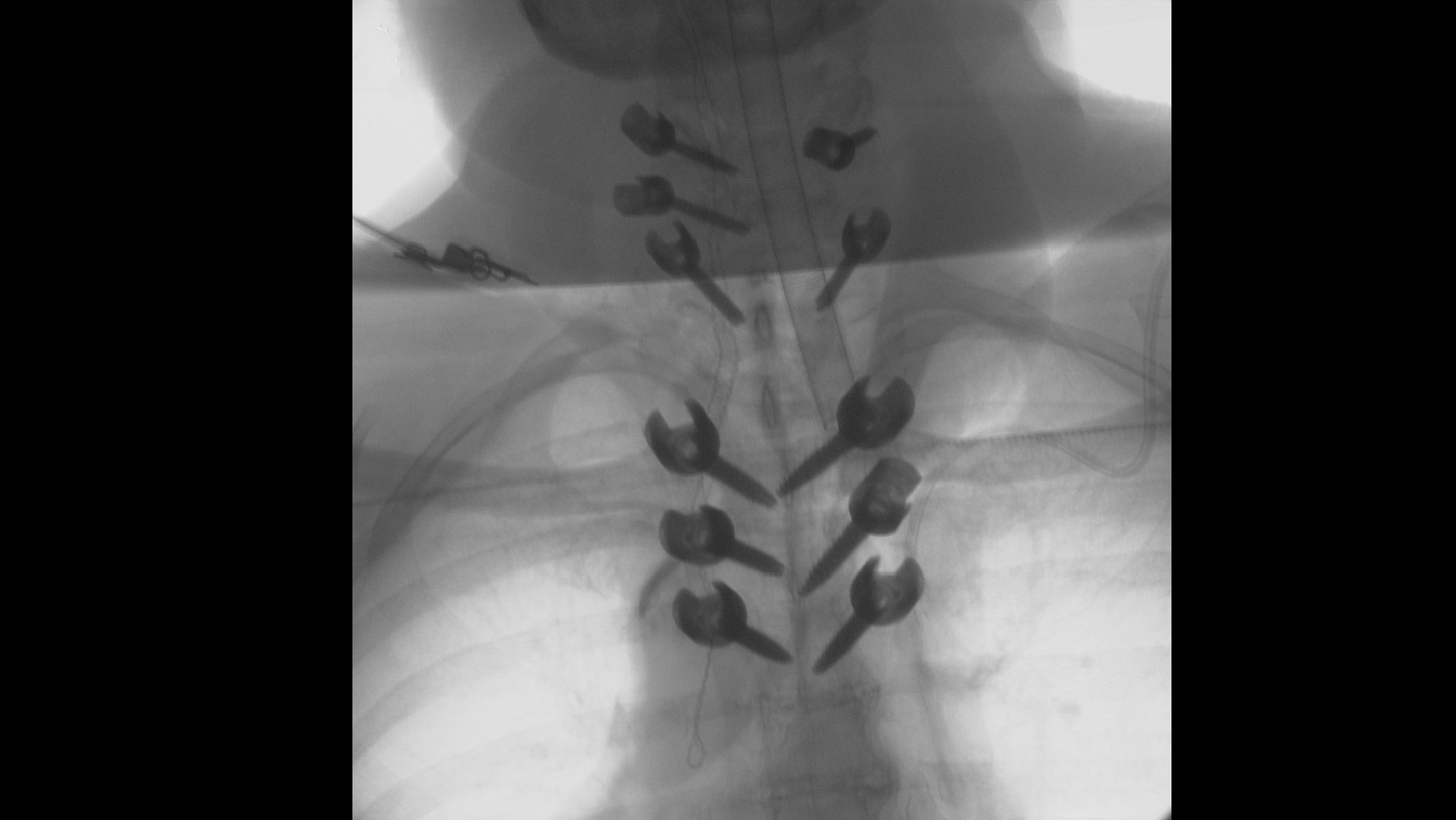 Spine surgery with Cios Fit, a mobile 2D C-arm for surgery.