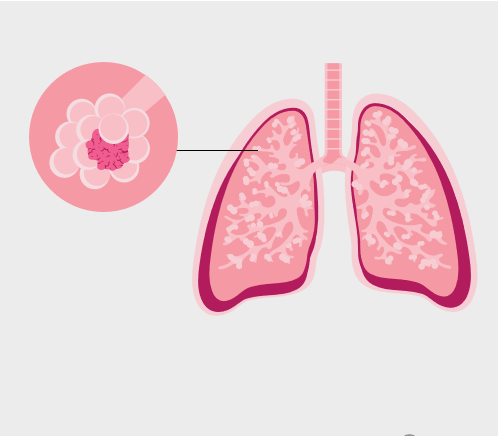 Adenocarcinoma Lung Cancer