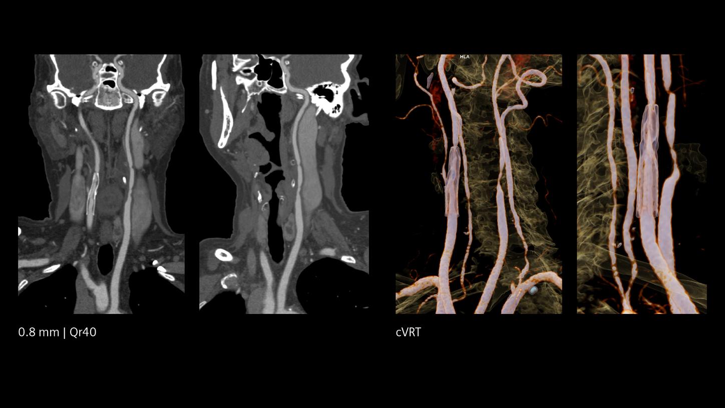 Carotid CTA stent visualization.