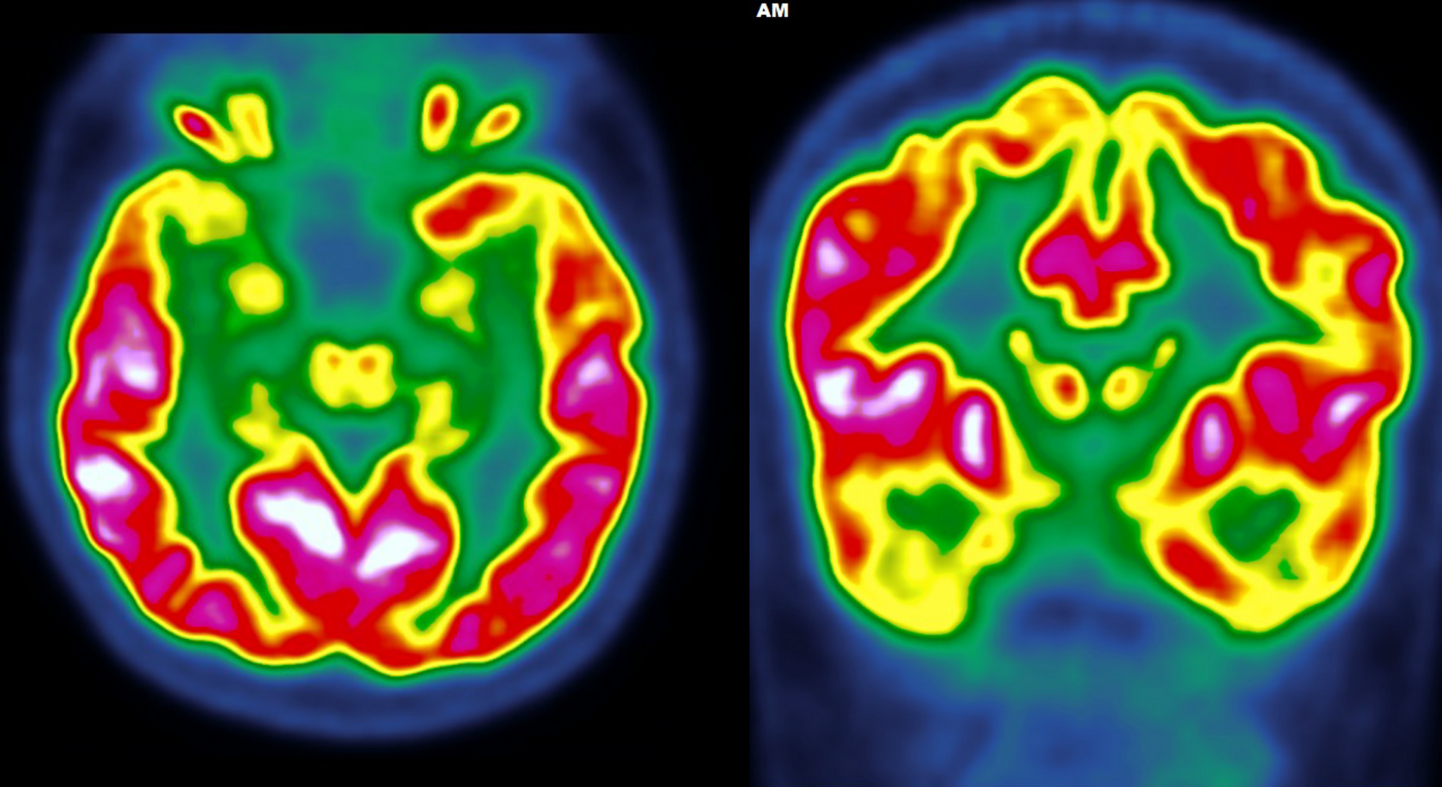 Decoding Brain Metabolism: Insights from 18F-FDG PET/CT Studies using ...
