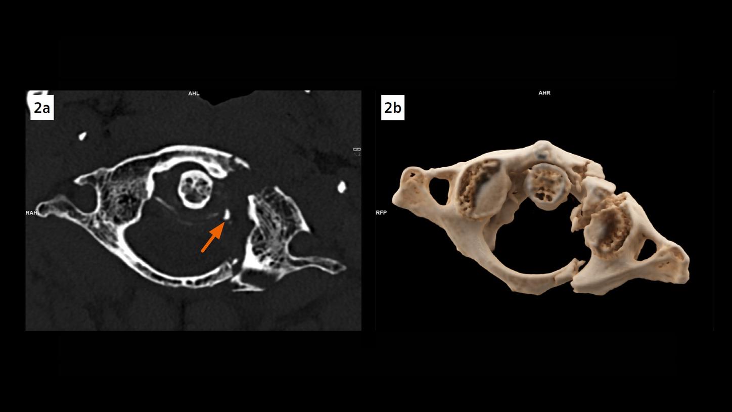 An axial image and a cVRT image show dislocated fractures of the anterior and posterior arches of C1 and a left massa lateralis avulsion fracture, with the dens axis dislocated to the left.