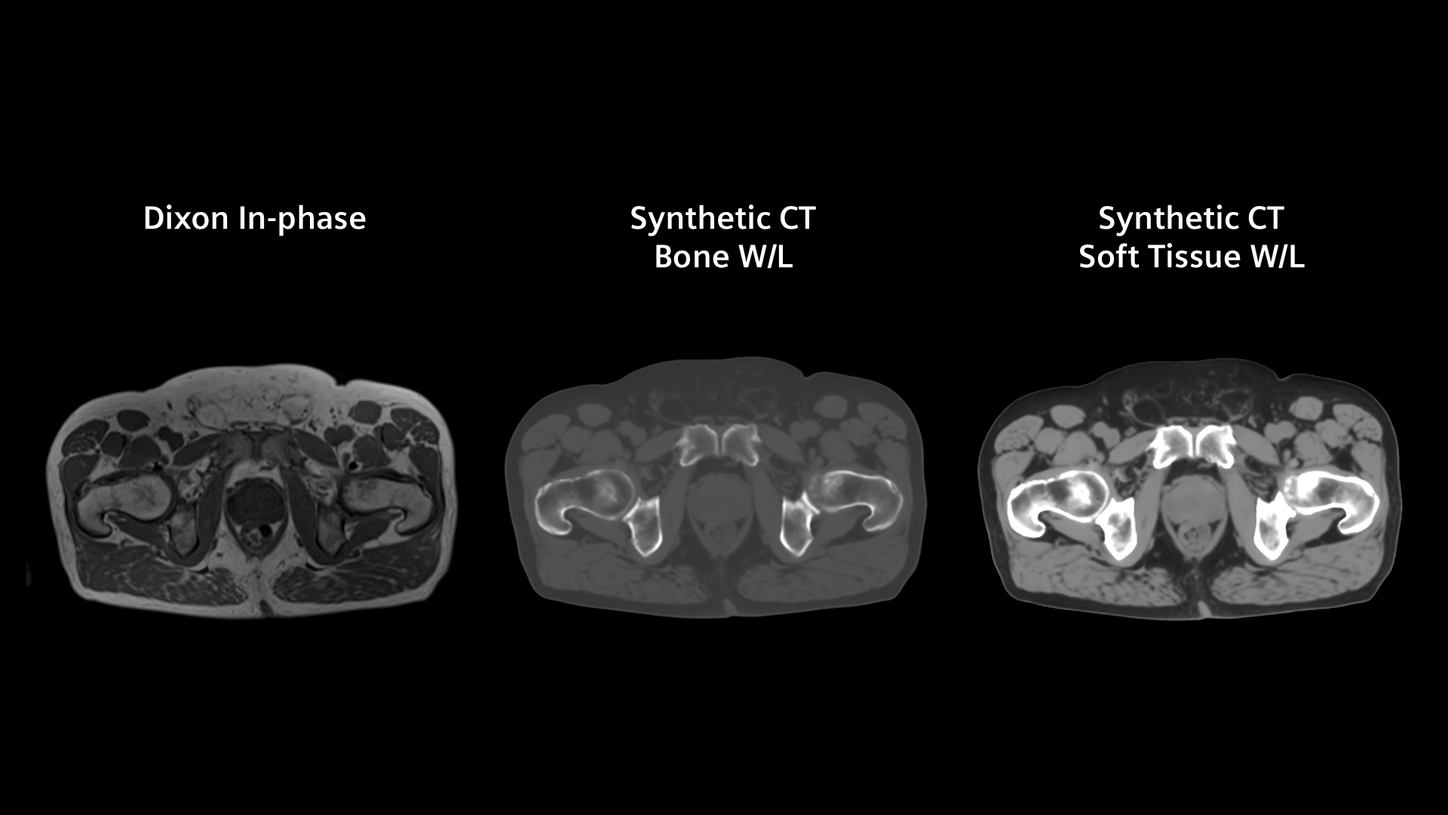  MR-based Synthetic CT results for pelvis 