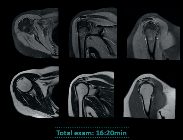 Metallic Implants: Imaging of Postoperative Changes