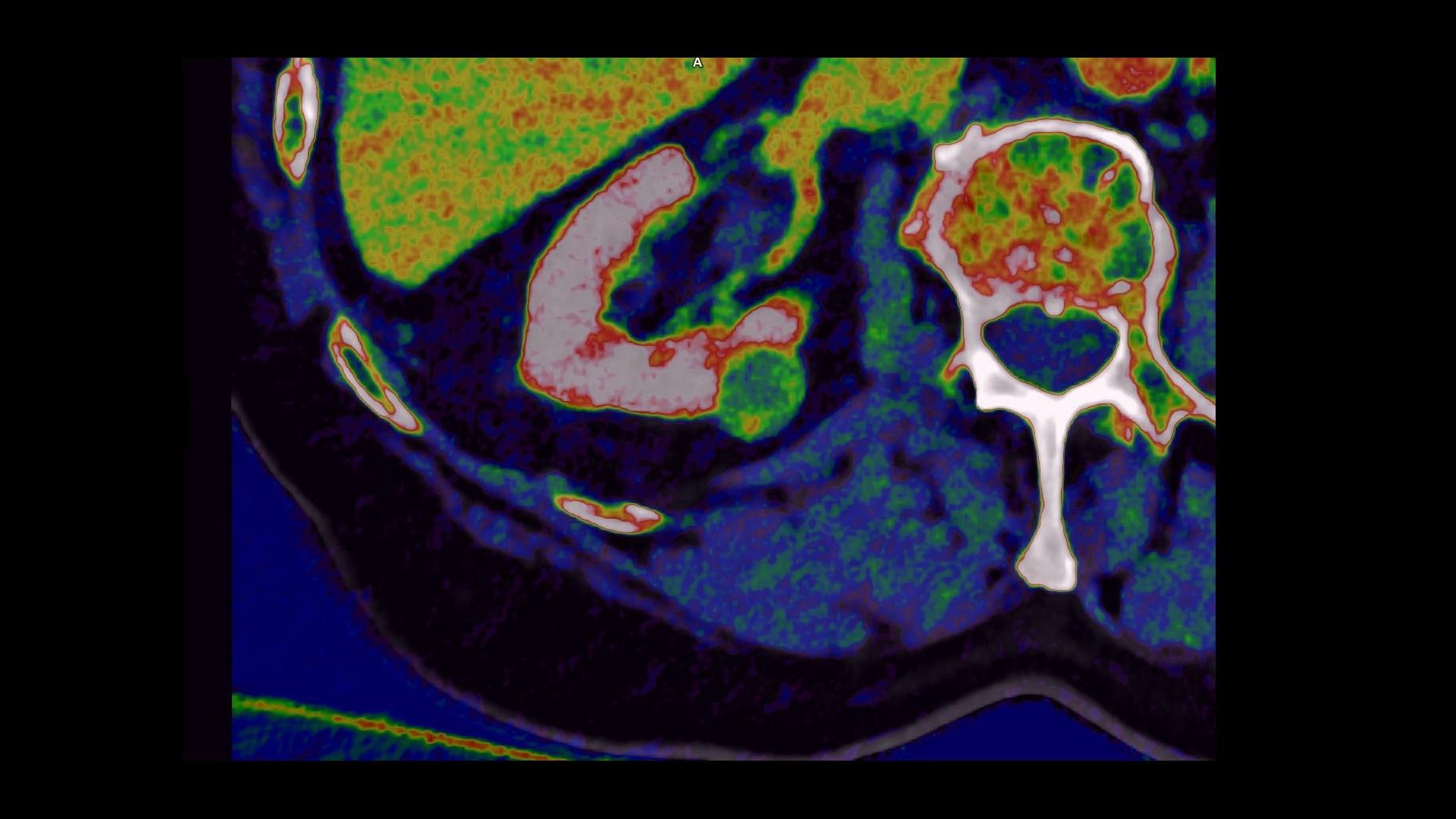 Inside an incidental solid renal mass (PDF) - Siemens Healthineers ...