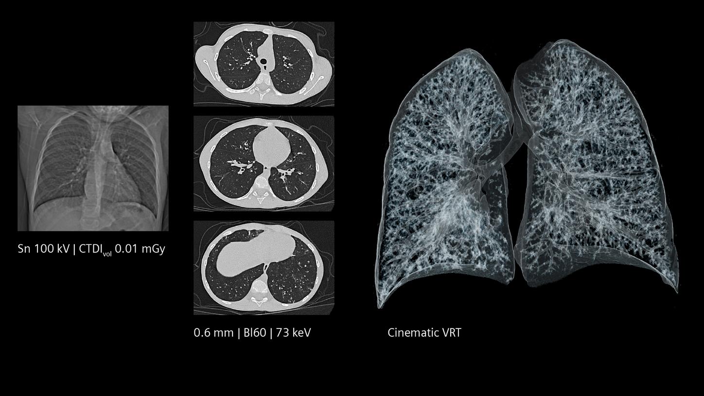 Low-dose lung imaging: sub-second imaging for pediatrics with high resolution.