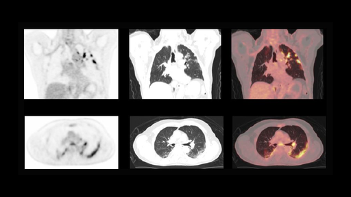 Incidental findings of COVID-19 in PET/CT imaging - Siemens Healthineers
