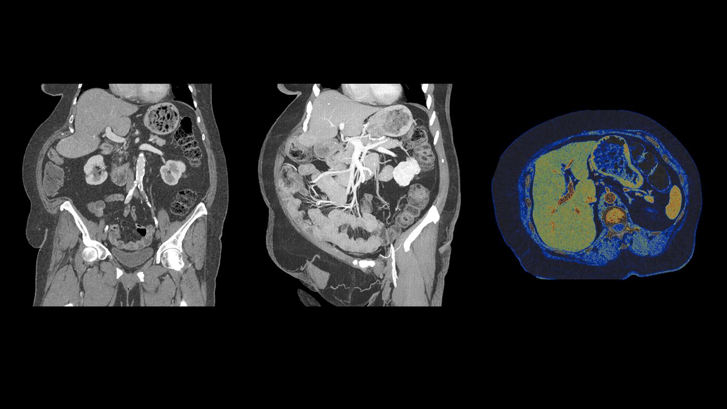 Abdomen image of an obese patient, acquired with NAEOTOM Alpha, combining high image-quality, speed, and spectral information. 