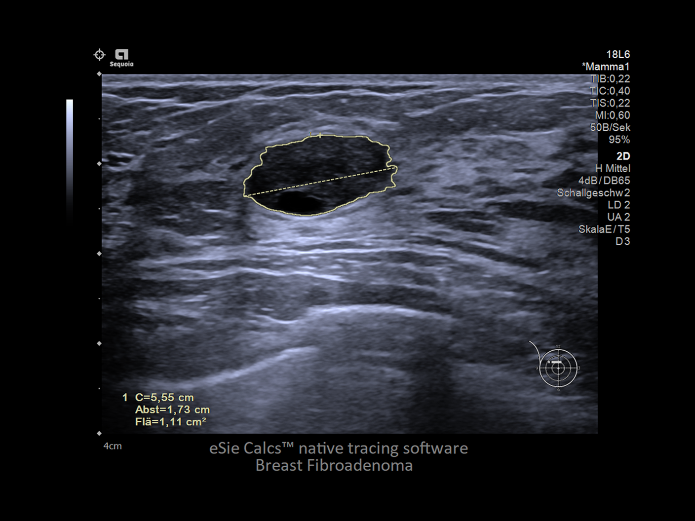 us-siemens-healthineers-ai-powered-auto-calcs-breast-care