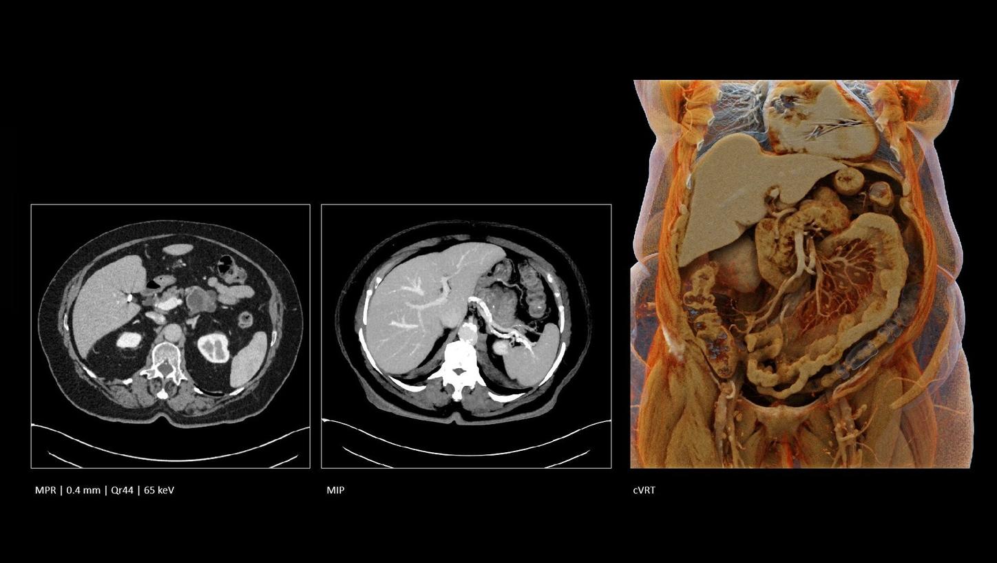 Pancreatic imaging of a patient with high BMI
