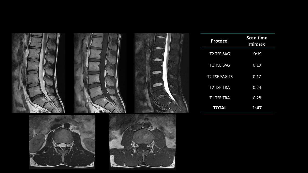 siemens-healthineers_magnetomworld_L-spine-rountine
