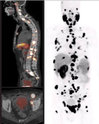Fig. 1: Baseline 68Ga-PSMA PET/CT scan