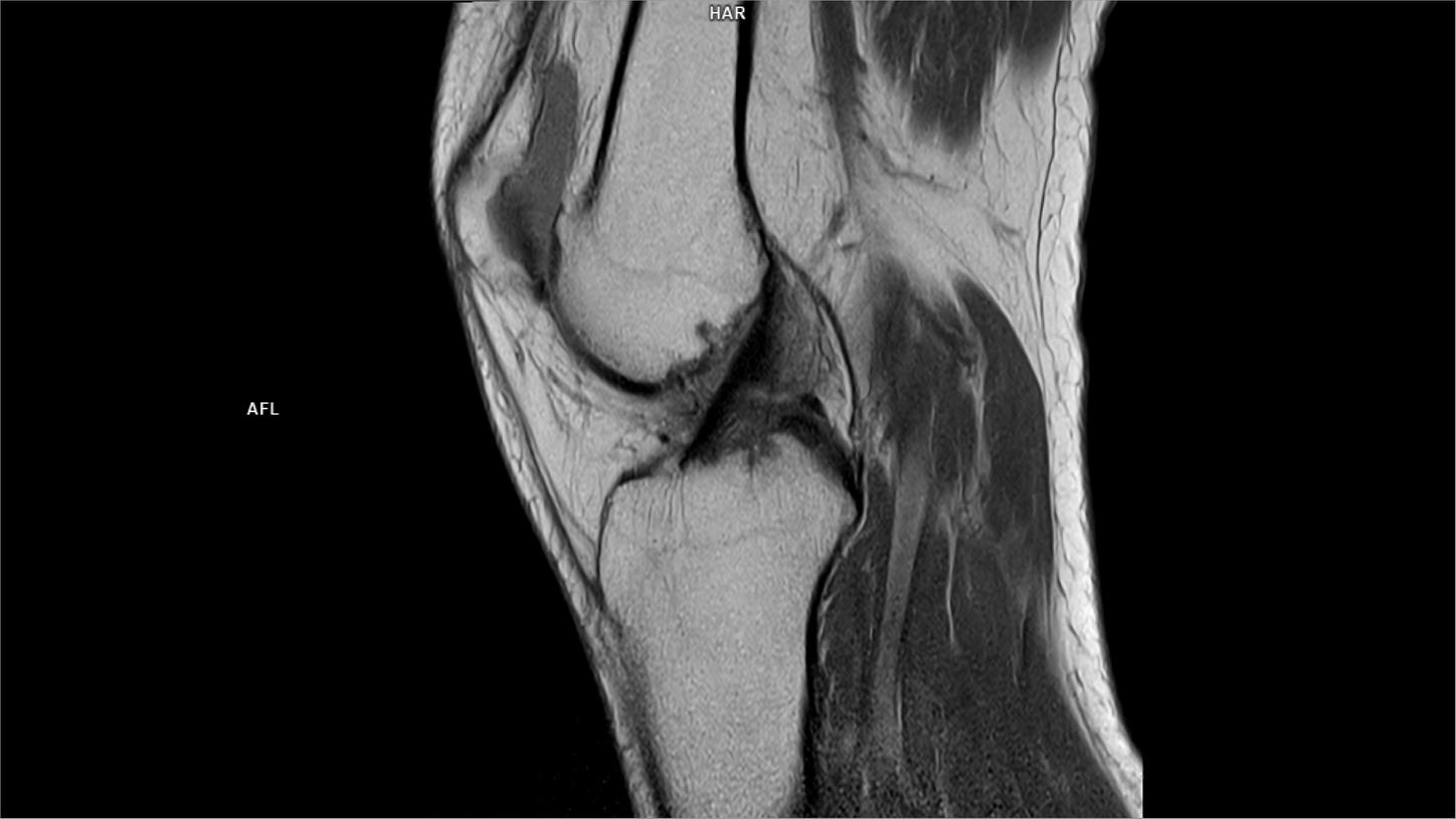 Sagittal PD-MAGNETOM Free.Max/Coil-Contour Small x2/Resolution-704/Scan Time-4:08/Aceleration-s2 DRS