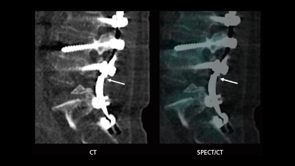 SPECT/CT imaging in the evaluation of pain following spinal fusion ...