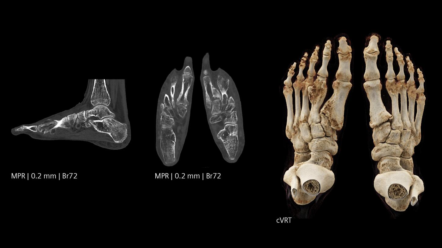 Visualization of the extension of bone destruction with Quantum HD