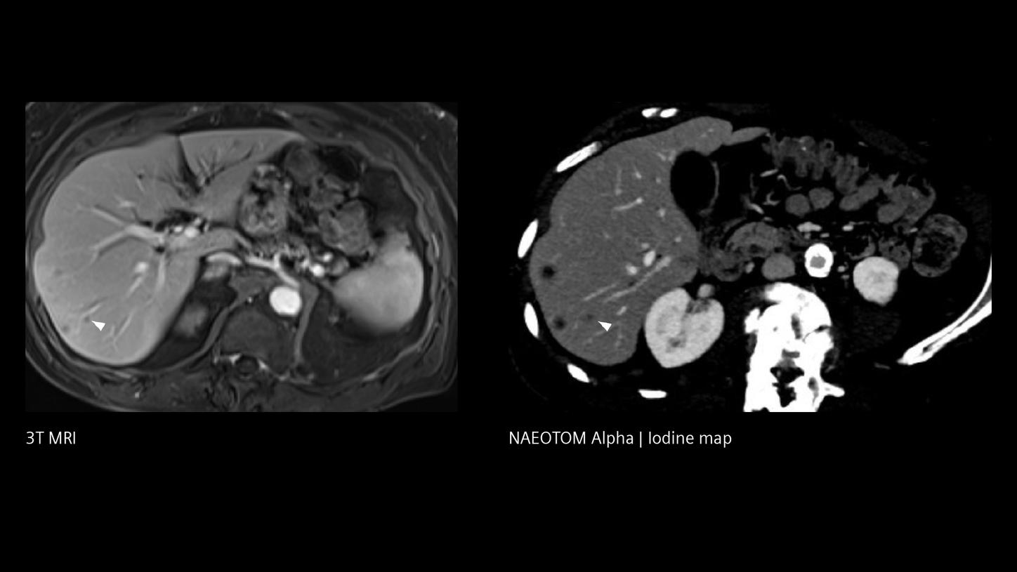 Clinical images of early-stage liver metastasis.