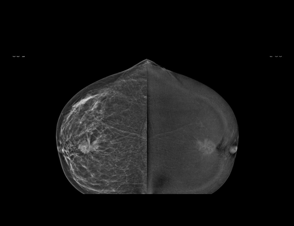 Mammo_left breast