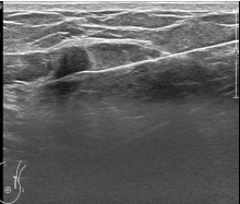 Image G: Ultrasound-guided true-cut biopsy image using a 14-gauge automated needle. The needle is shown passing through the mass in the upper outer left breast.