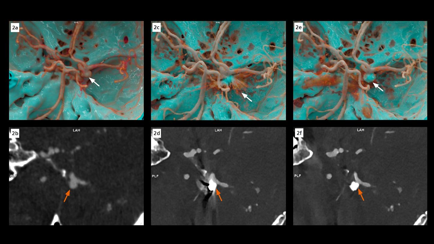 cVRT and MPR images show the head view of the cerebral arteries. Images acquired with an EID-CT prior to the coiling embolization show an aneurysm located at the C7 segment of the right ICA. Postcoiling images acquired with PCD-CT without iMAR show metal artifacts obscuring the visibility of the aneurysm and the adjacent structures. The completely embolized aneurysm, without signs of remnants, as well as patent right ICA, ACA and MCA, are clearly visualized in the images with iMAR. Note the improvement of the vessel delineation, sharpness and contrast in the PCD-CT images.