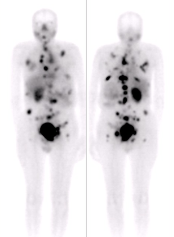 Fig. 2: 177Lutetium-PSMA 1st dose SPECT scan